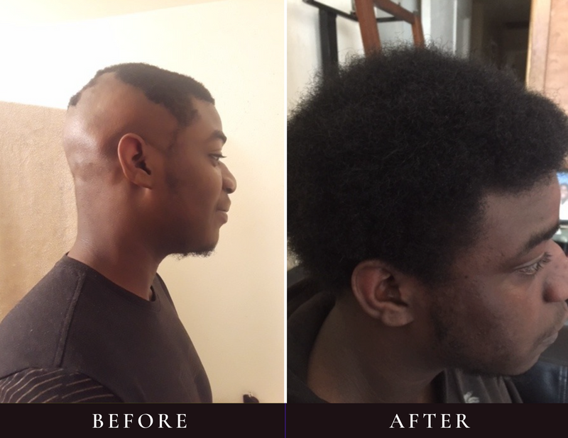 Simmons R. before and after